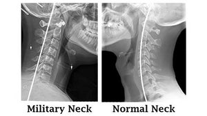 I have a straight neck. Anyway to get the proper curvature back?