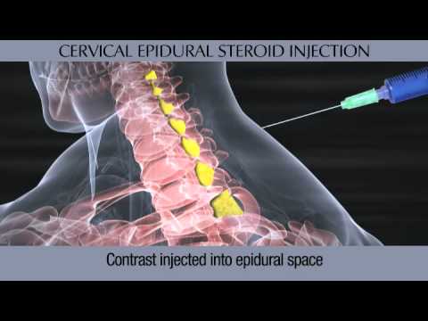 Can a Epidural Injection - Cortisone Shot Help your neck pain?