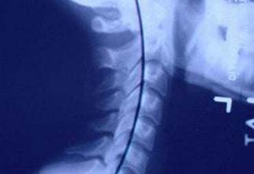 Proper Neck Alignment- What in Normal Vs Abnormal?