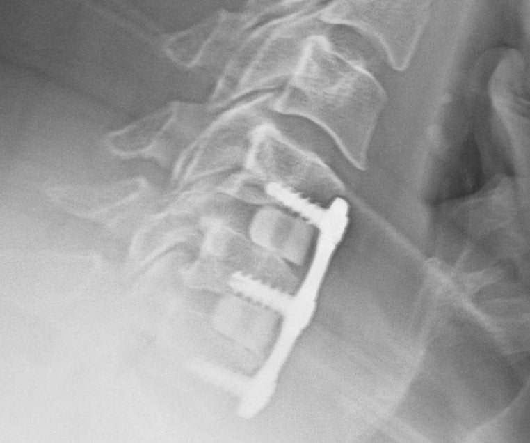 Does the Arc4life Traction Pillow Work After a Fusion Surgery...Not Always