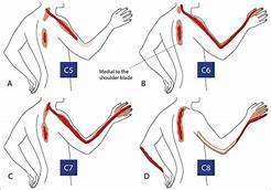 Can Neck Pain Affect Your Arms?