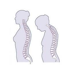 Get Rid of Hunch Back Posture and Forward Head Posture